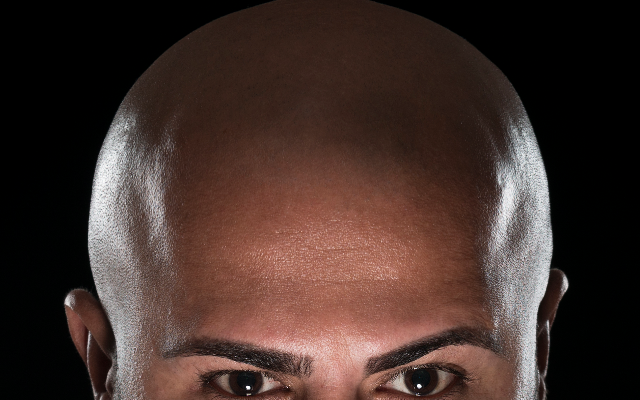 It Takes 2 1/2 Years for Men to Admit They’re Balding